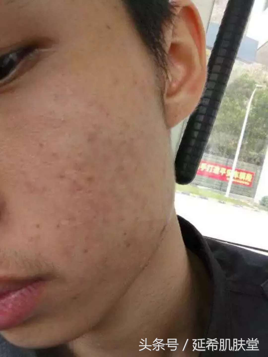 不想自己长痘怎么办,五天淡痘印的办法