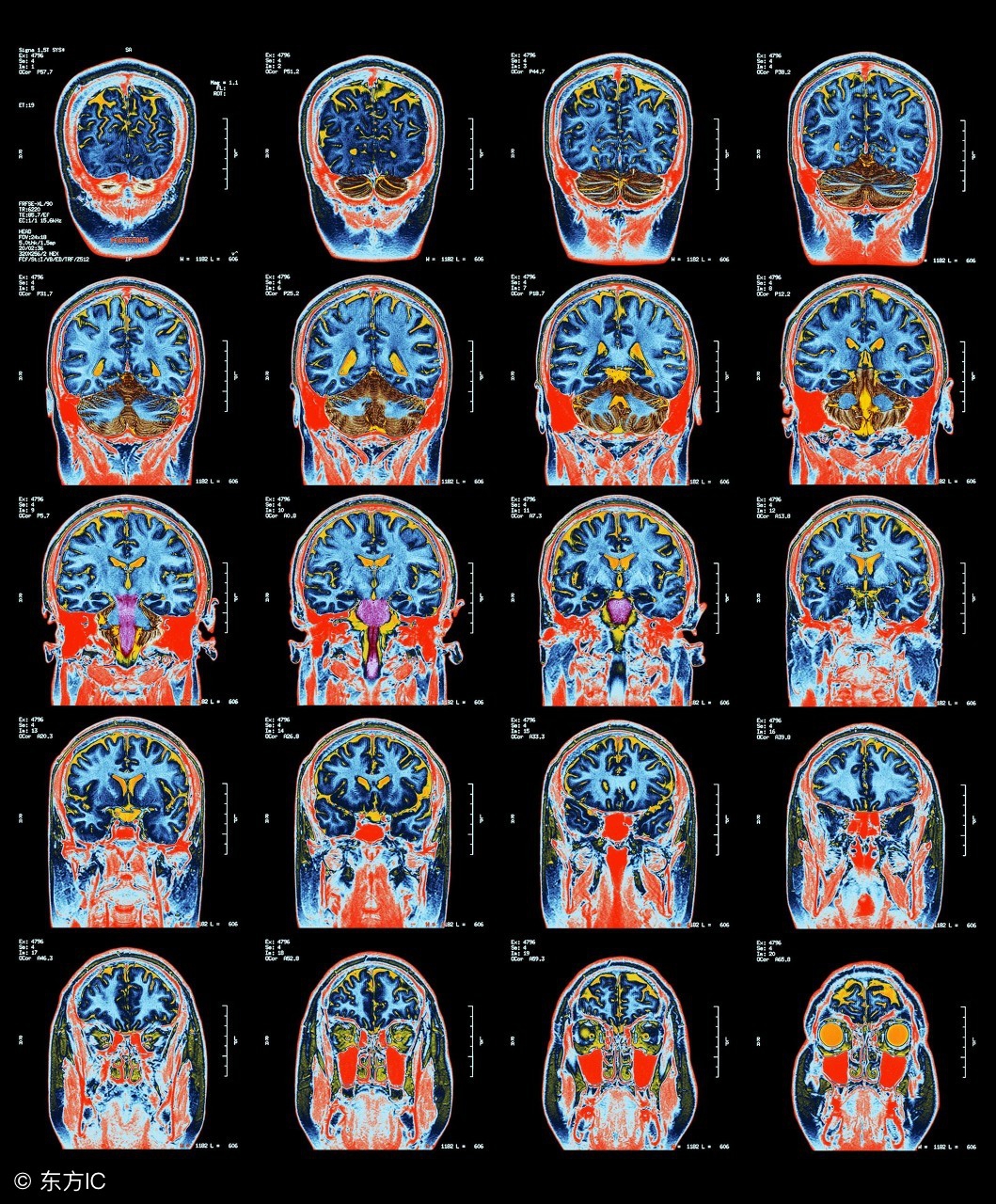 董氏针灸治小脑萎缩视频,中医针灸治疗小脑萎缩案例