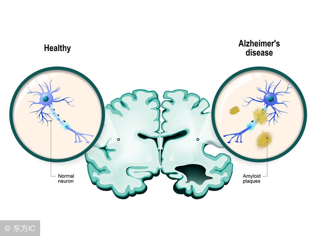 小脑萎缩犯法负法律责任吗,脑梗小脑萎缩什么方法治愈最好