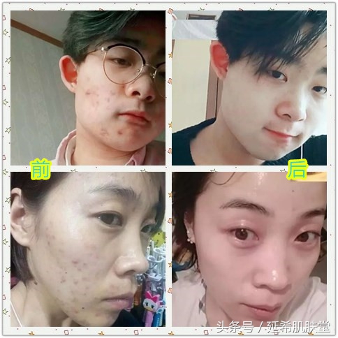 不想自己长痘怎么办,五天淡痘印的办法