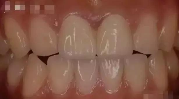 牙医建议烤瓷不建议全瓷,牙医建议整牙吗