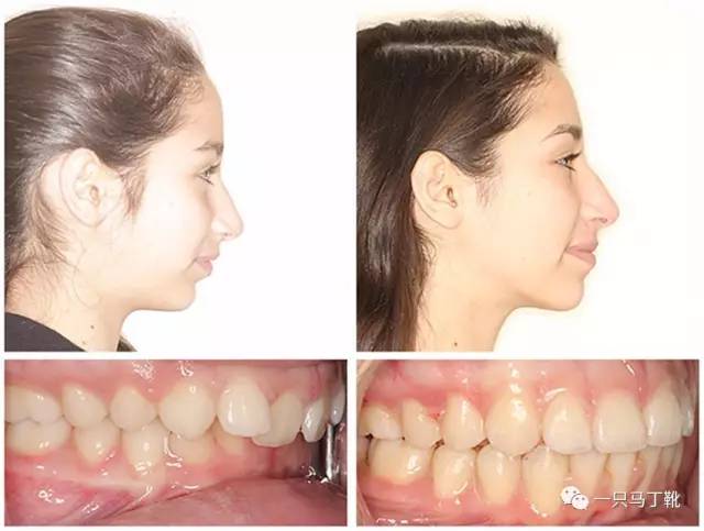 凸下巴凹面型脸怎么改变,脸宽但下巴尖怎么瘦下来