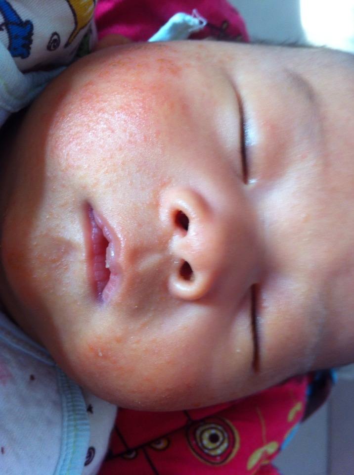 不同部位的湿疹怎么治疗,湿疹5个护理方法大家一起看一看