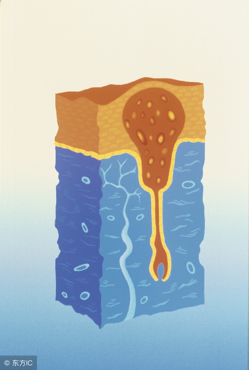 患了毛囊炎防治也是一个重要的环节