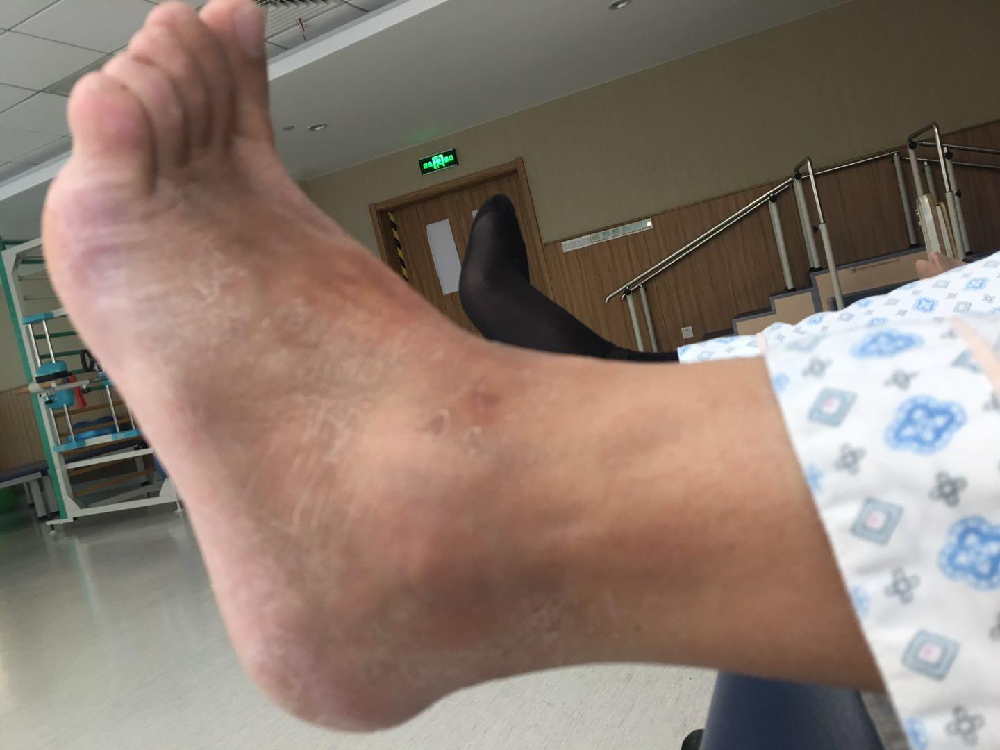 伤筋动骨真的需要休息一百天吗,伤筋动骨100天正确吗