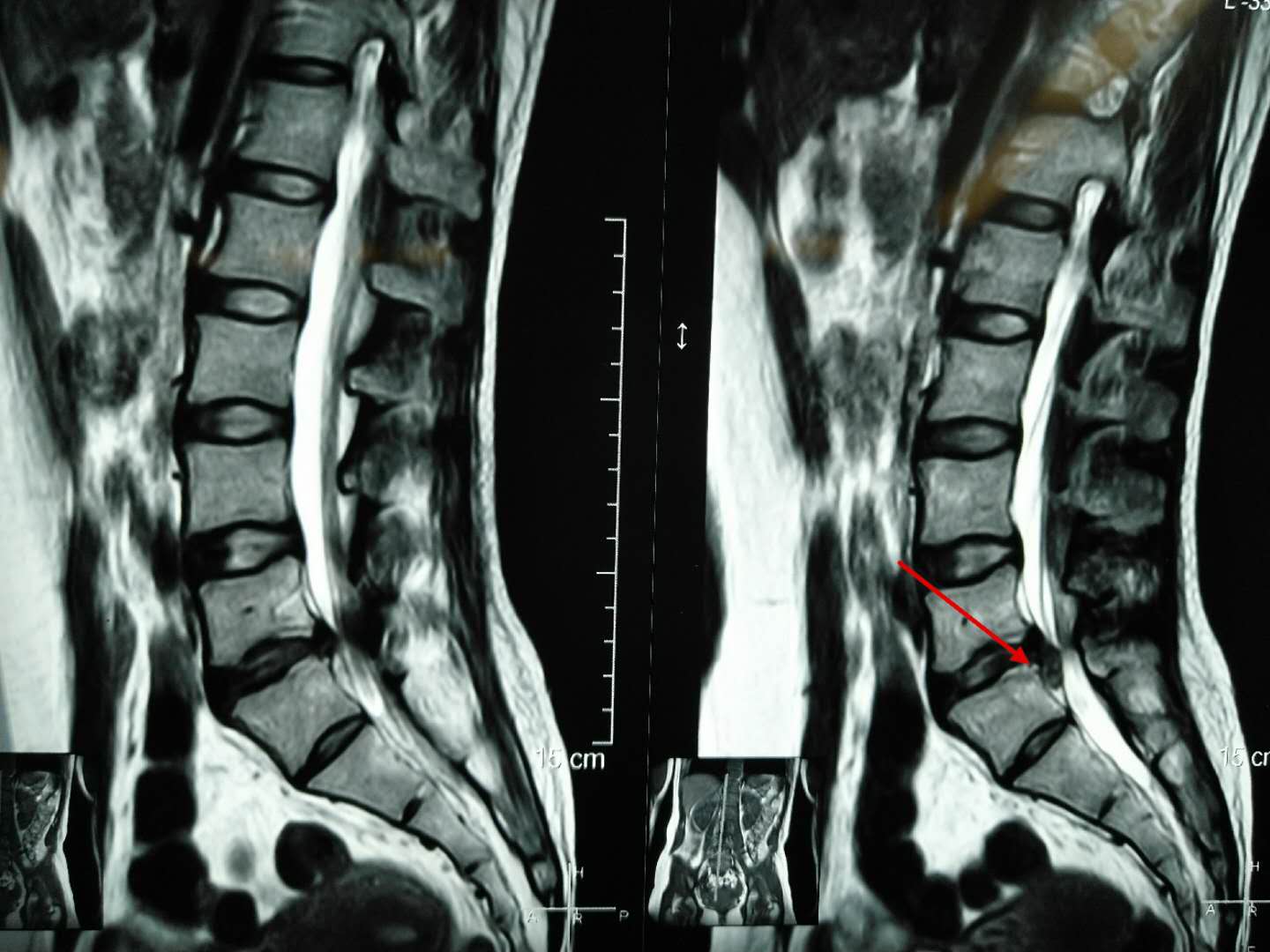 什么叫微创脊柱内镜手术,全可视脊柱内镜技术