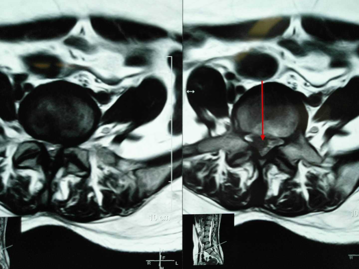 什么叫微创脊柱内镜手术,全可视脊柱内镜技术