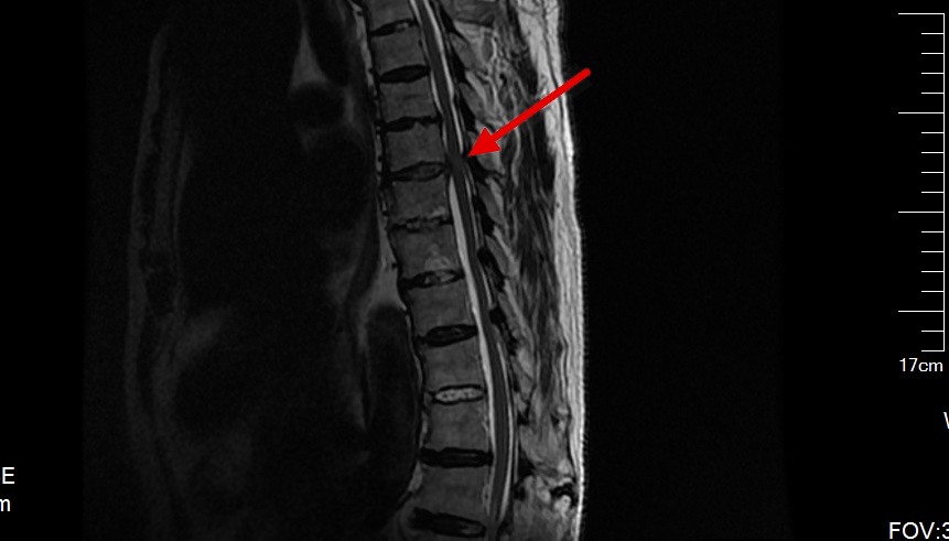 什么叫微创脊柱内镜手术,全可视脊柱内镜技术
