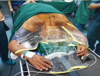 什么叫微创脊柱内镜手术,全可视脊柱内镜技术