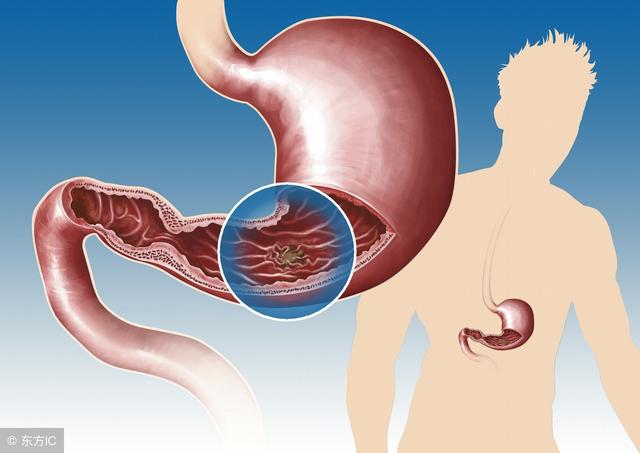 长期胃溃疡是不是容易引发胃癌,胃溃疡长期吃什么药治疗