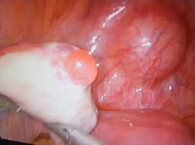 排卵期运动会造成排卵期出血,排卵期出血的原因和解决方法