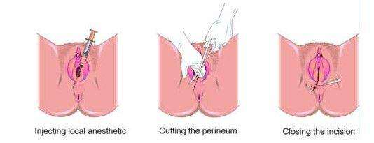 10个顺产9个侧切？关于侧切的这些小常识你必须懂！