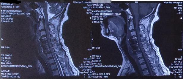 神经根型颈椎病大夫让按摩推拿,祖传神经根型颈椎病正骨复位手法