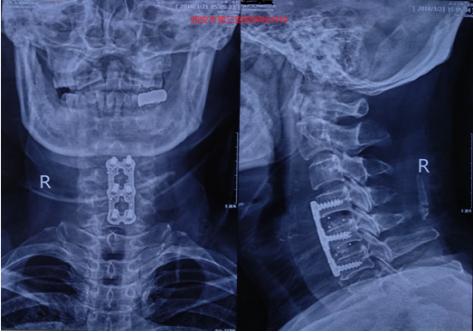 神经根型颈椎病大夫让按摩推拿,祖传神经根型颈椎病正骨复位手法