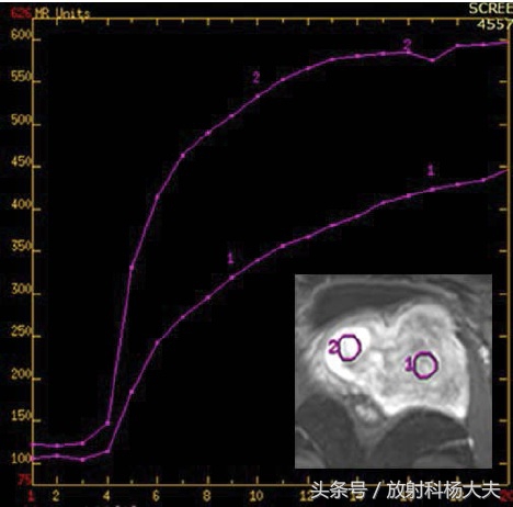 什么情况医生建议做盆腔核磁,女性盆腔增强核磁能看到什么病