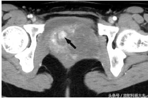 什么情况医生建议做盆腔核磁,女性盆腔增强核磁能看到什么病