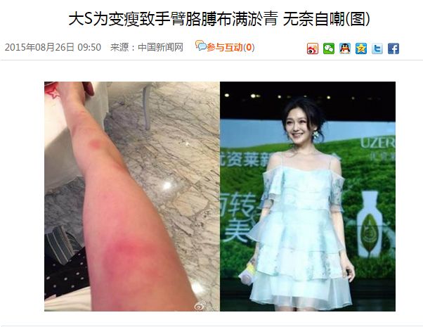 大s癫痫住院真相,大s回应因癫痫住院一事