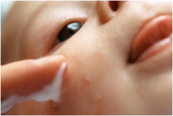 脸上出湿疹样的疙瘩咋回事,小孩脸上起疙瘩和湿疹的区别