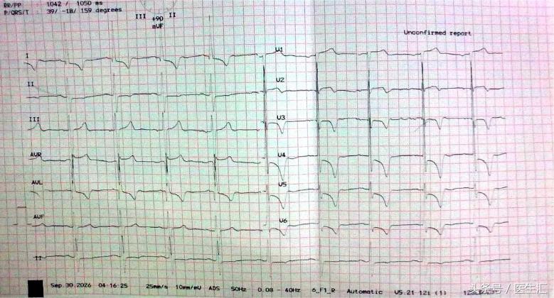 高龄心衰患者怎么做降压治疗?