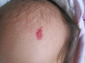 典型血管瘤和不典型血管瘤的区别,不典型肝血管瘤和典型血管瘤区别