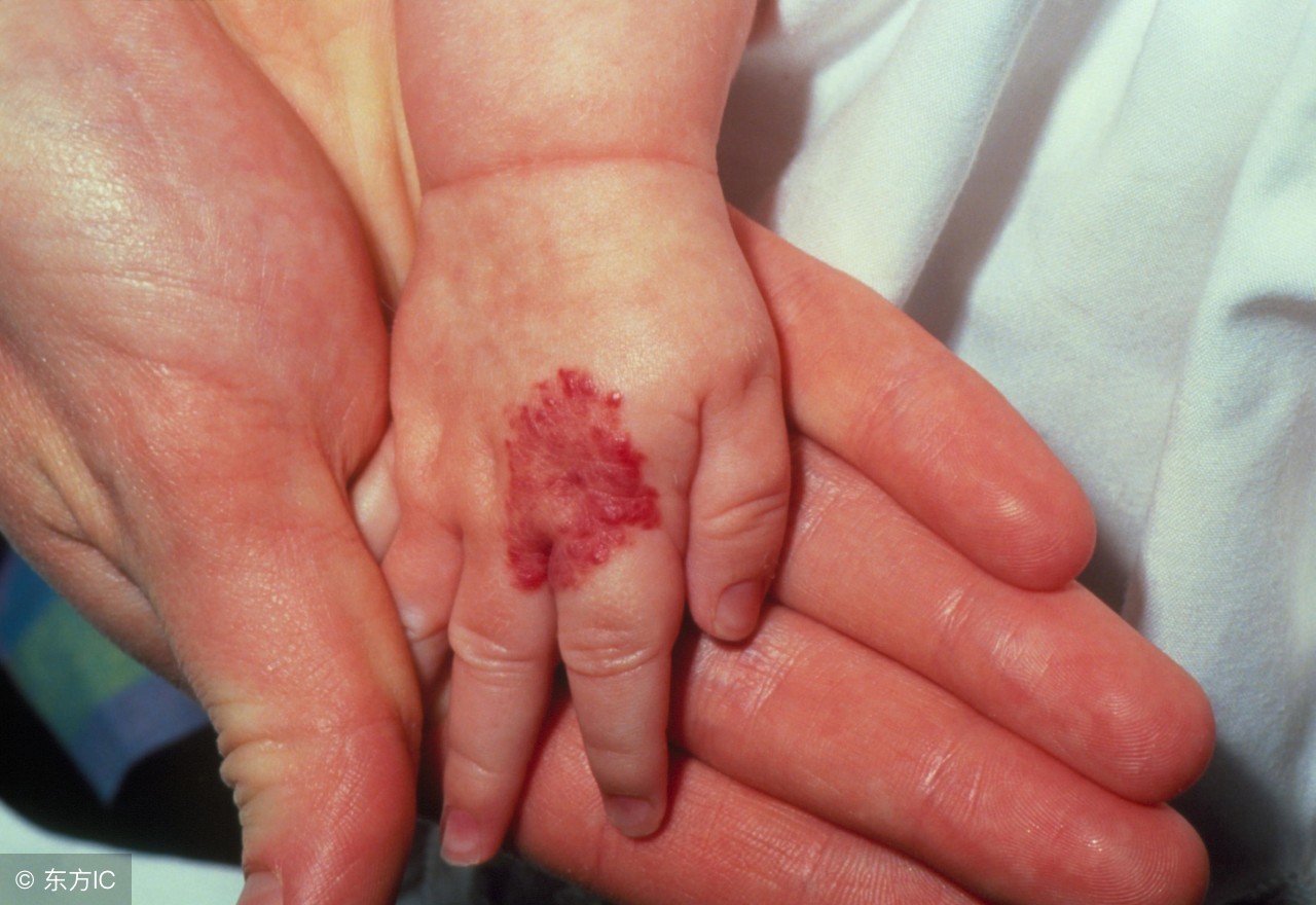 典型血管瘤和不典型血管瘤的区别,不典型肝血管瘤和典型血管瘤区别