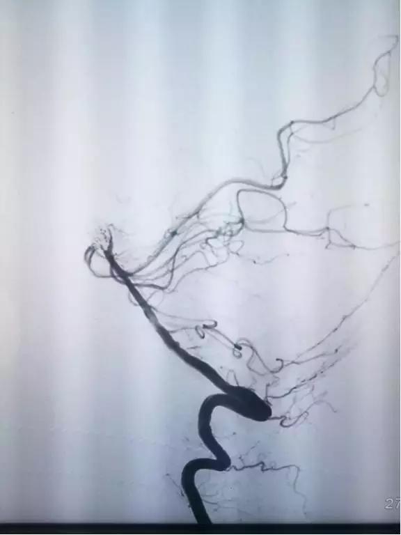 介入栓塞动脉瘤,颅内动脉瘤介入栓塞术全过程