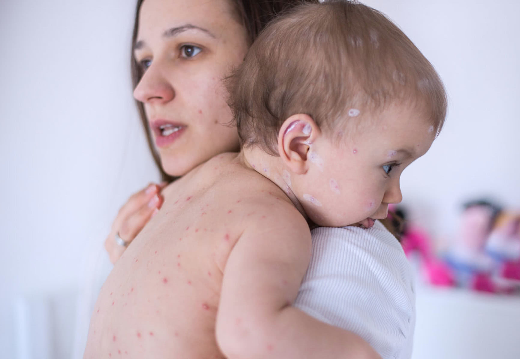 一岁宝宝对鸡蛋过敏怎么回事,七个月宝宝吃鸡蛋过敏是什么症状