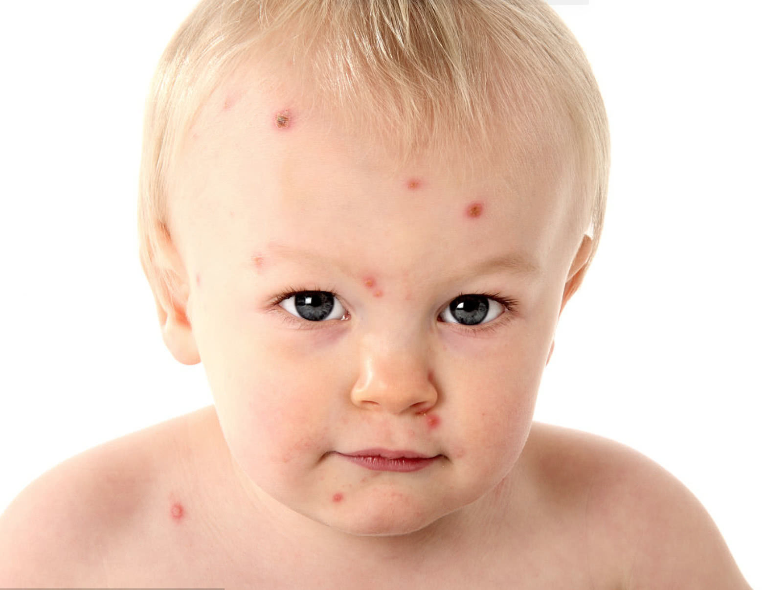 一岁宝宝对鸡蛋过敏怎么回事,七个月宝宝吃鸡蛋过敏是什么症状