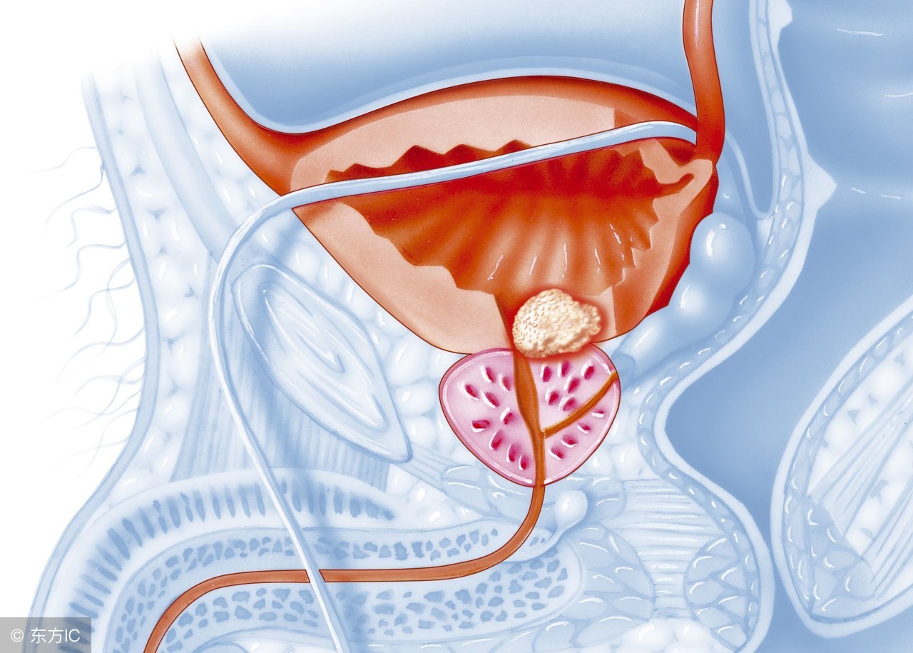 微波治疗前列腺炎危害,前列腺炎如果不治疗有什么后果