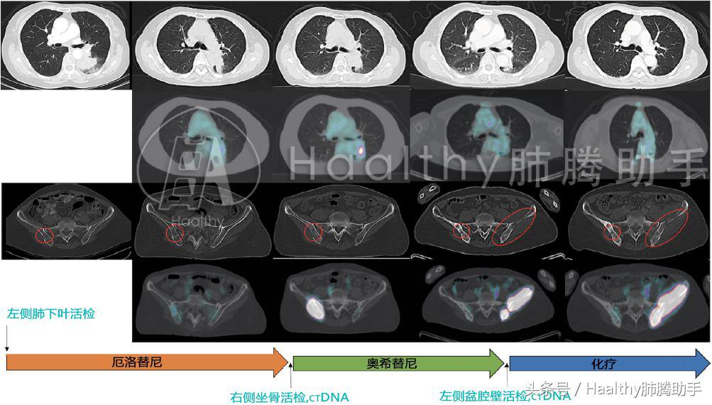 奥希替尼耐药临床试验,一线奥希替尼耐药机制更复杂