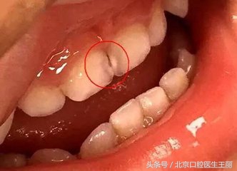 牙齿咬合疼痛一定要根管治疗吗,儿童牙齿根管治疗医保能报销吗