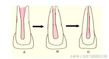 牙齿咬合疼痛一定要根管治疗吗,儿童牙齿根管治疗医保能报销吗