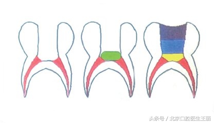 牙齿咬合疼痛一定要根管治疗吗,儿童牙齿根管治疗医保能报销吗