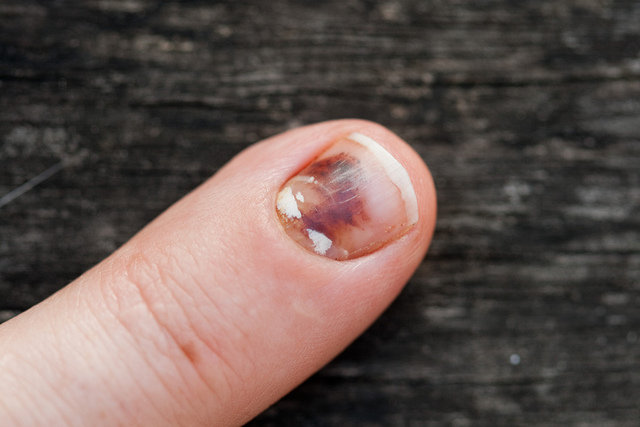 指甲出现黑线是什么原因,指甲有黑线竖纹是什么原因