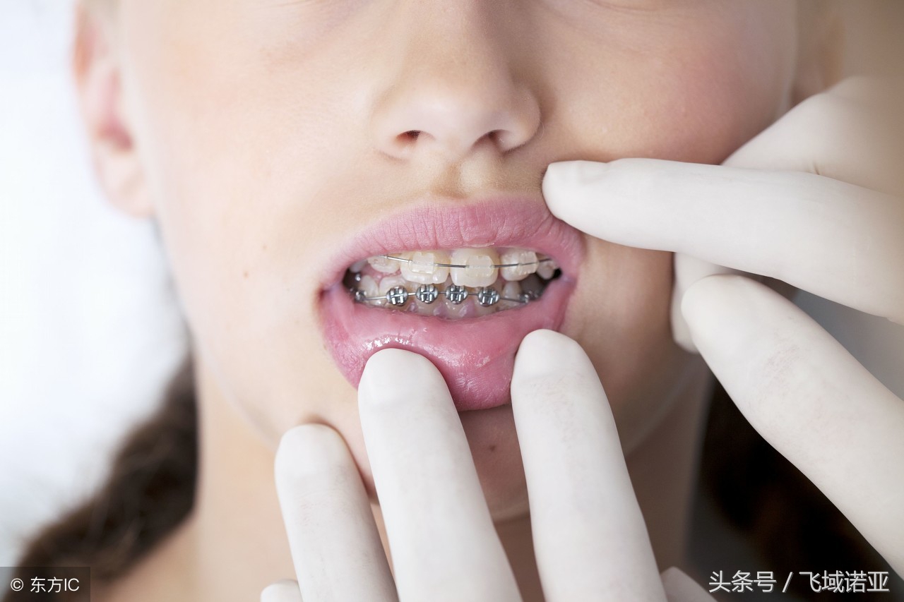 钢牙牙套妹,牙套妹抖音钢牙