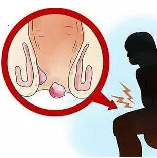 痔疮如何预防和治愈,热水熏蒸治痔疮是最大的误区