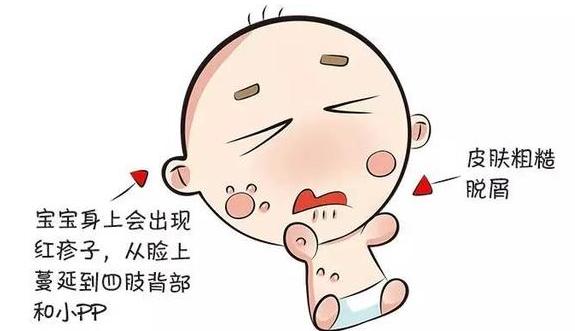 关于儿童湿疹你必须了解的事,宝宝湿疹说说