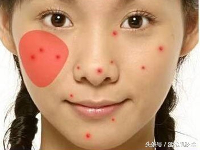 下巴不停冒脓包型痘痘怎么样调理,下巴长满痘痘是什么原因怎么调理