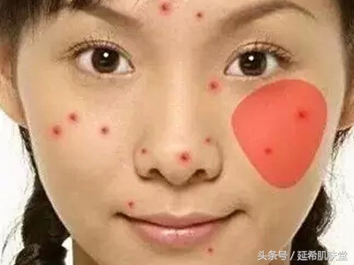 下巴不停冒脓包型痘痘怎么样调理,下巴长满痘痘是什么原因怎么调理