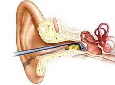 耵聍栓塞可以导致耳聋吗,耵聍栓塞耳朵能治吗