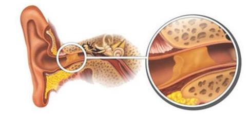 耵聍栓塞可以导致耳聋吗,耵聍栓塞耳朵能治吗