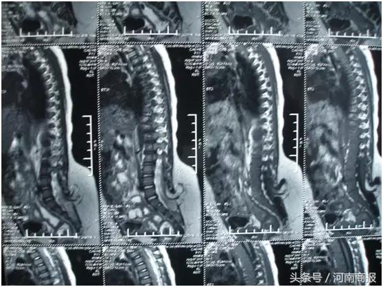 十二岁男童尿床是什么原因,男孩12岁尿床正常吗