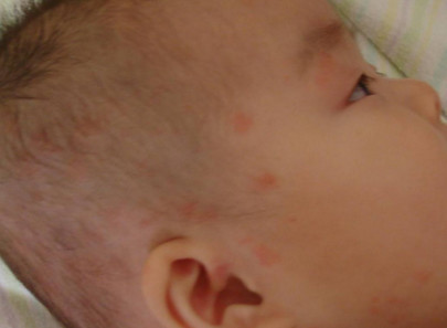 宝宝湿疹的护理和保湿方法,宝宝湿疹怎么护理最有效