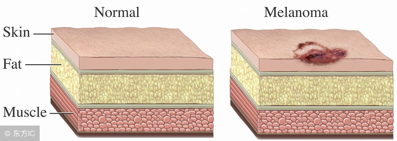 黑色素瘤治疗最佳方案,黑色素瘤末期的表现