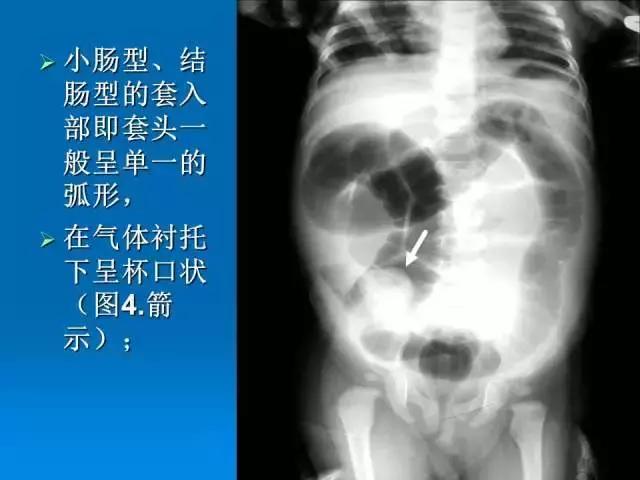 儿童肠套叠空气灌肠后遗症,儿童肠套叠空气灌肠复发几率高吗