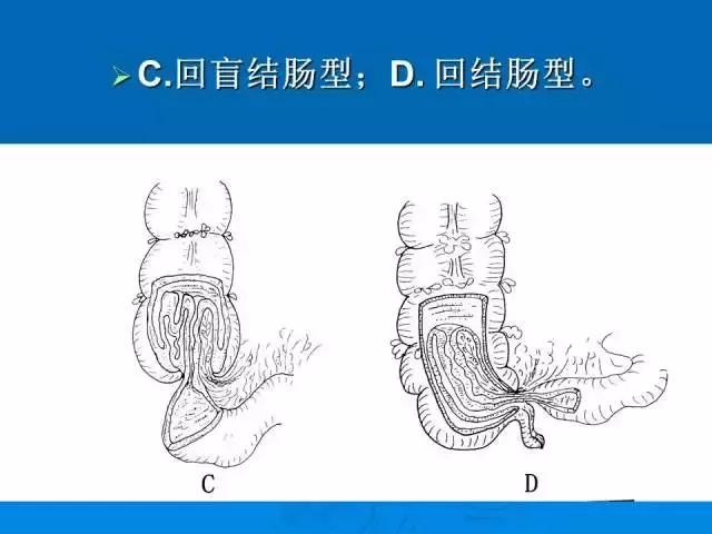 儿童肠套叠空气灌肠后遗症,儿童肠套叠空气灌肠复发几率高吗