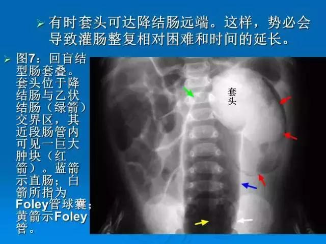 儿童肠套叠空气灌肠后遗症,儿童肠套叠空气灌肠复发几率高吗