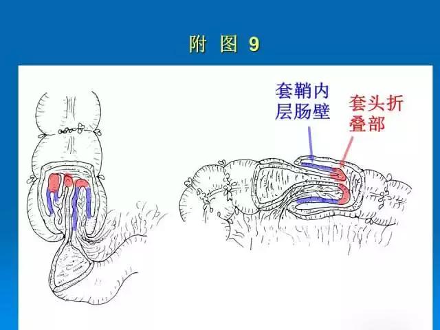 儿童肠套叠空气灌肠后遗症,儿童肠套叠空气灌肠复发几率高吗