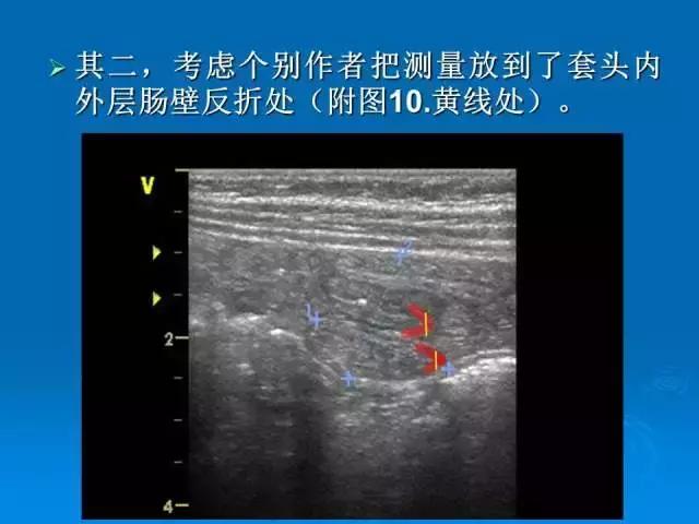 儿童肠套叠空气灌肠后遗症,儿童肠套叠空气灌肠复发几率高吗
