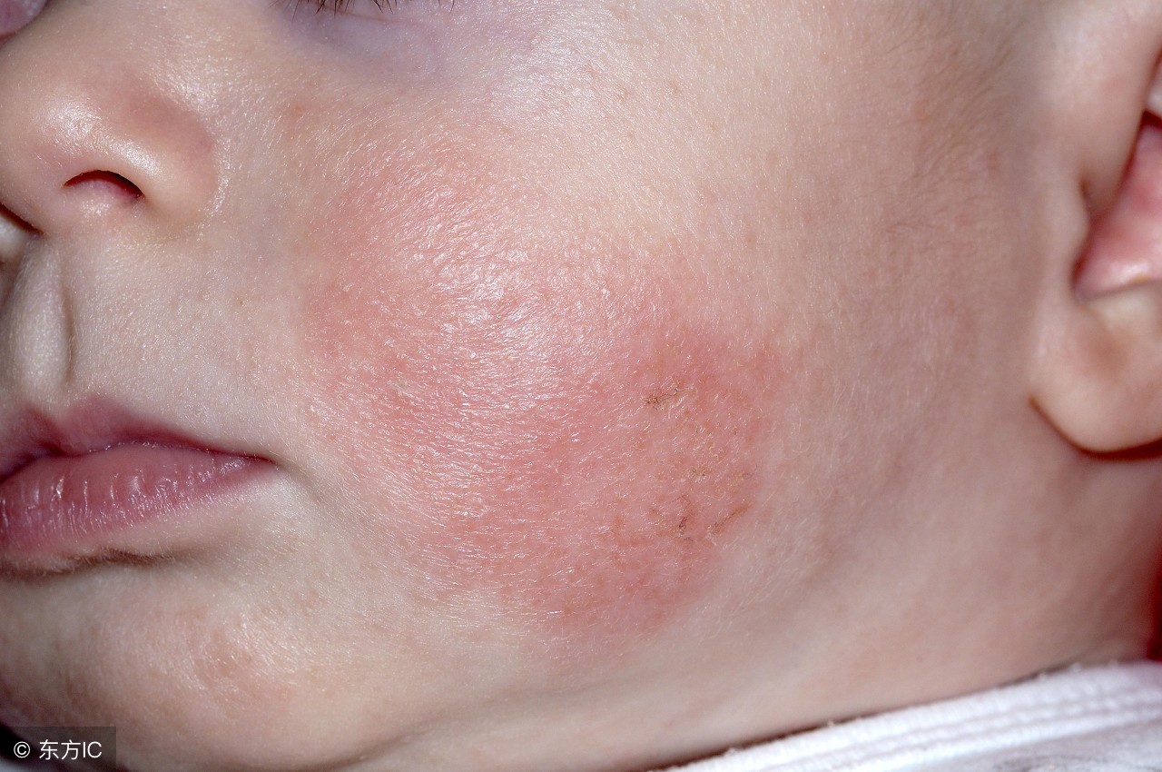 宝宝长湿疹原因,四个月的婴儿口水疹和湿疹的区别